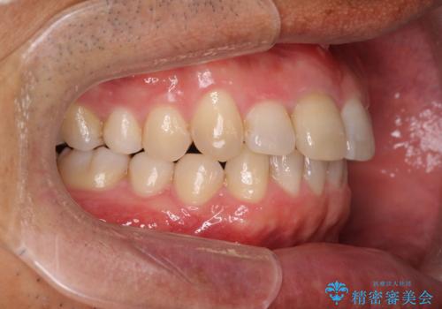 2級ディープバイト 遠心移動を伴うマウスピース矯正の治療後