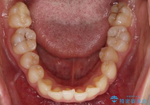 【非抜歯】結婚式に向けて矯正で素敵な笑顔を!の治療前