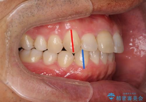 2級ディープバイト 遠心移動を伴うマウスピース矯正の症例 治療後