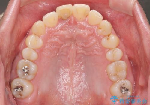 2級ディープバイト 遠心移動を伴うマウスピース矯正の治療後