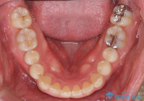 2級ディープバイト 遠心移動を伴うマウスピース矯正の治療後