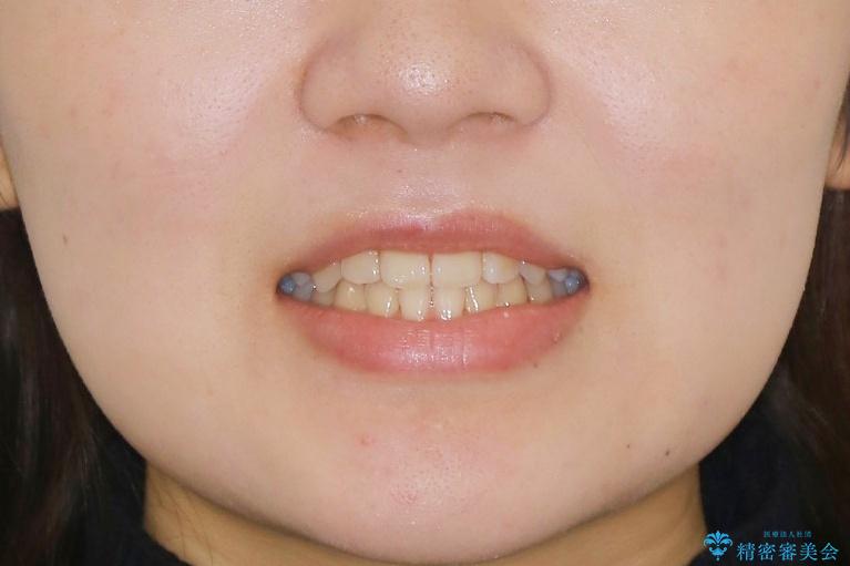 【非抜歯】受け口の改善　10代で始める本格的噛み合わせ治療の治療後（顔貌）
