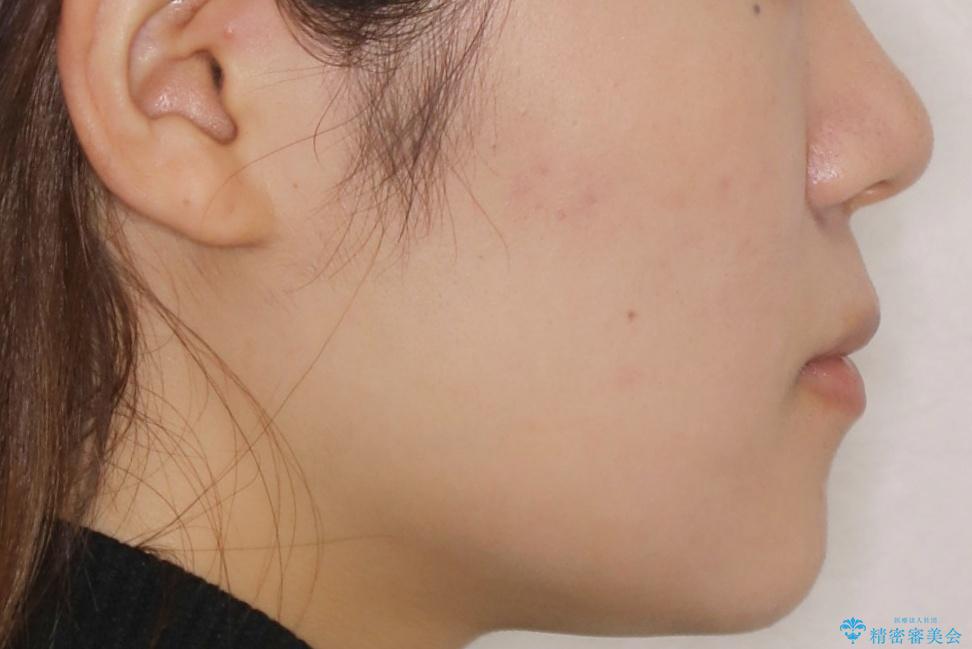 【非抜歯】受け口の改善 10代で始める本格的噛み合わせ治療の治療後(顔貌)