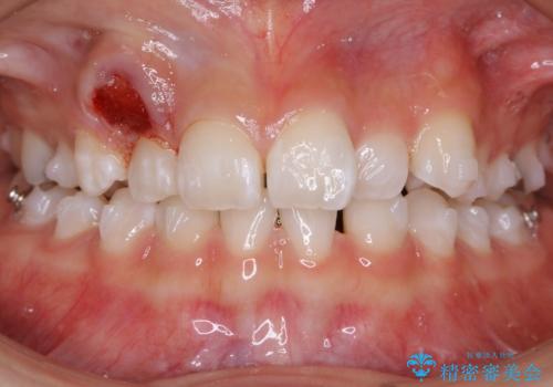 【抜歯】歯の先天欠如 歯の本数が上下で違う場合の治療の治療中
