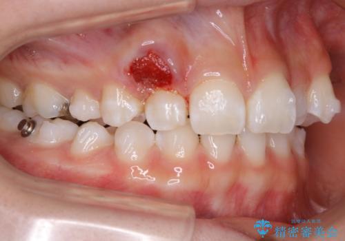 【抜歯】歯の先天欠如　歯の本数が上下で違う場合の治療の治療中