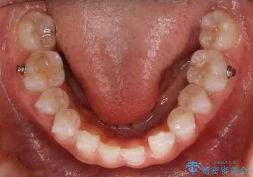 【抜歯】歯の先天欠如　歯の本数が上下で違う場合の治療の治療中