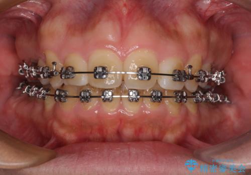 【モニター】後戻りで飛び出してきた前歯 ワイヤー装置での再矯正の治療中