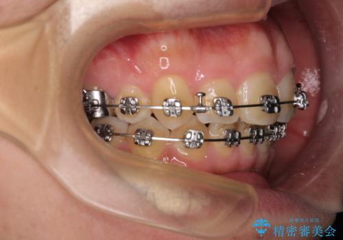 【モニター】後戻りで飛び出してきた前歯 ワイヤー装置での再矯正の治療中