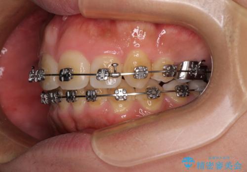 【モニター】後戻りで飛び出してきた前歯 ワイヤー装置での再矯正の治療中