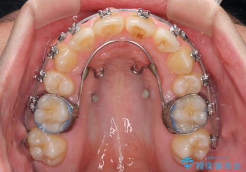 【モニター】後戻りで飛び出してきた前歯 ワイヤー装置での再矯正の治療中