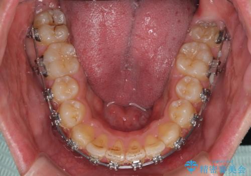 【モニター】後戻りで飛び出してきた前歯 ワイヤー装置での再矯正の治療中