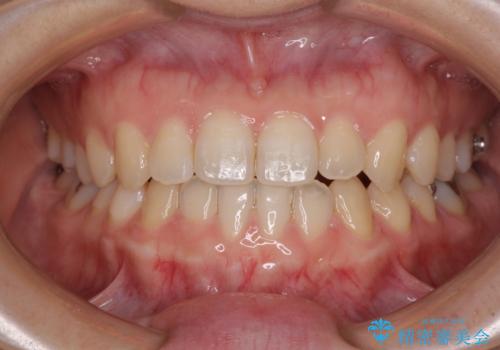 前歯のクロスバイト インビザラインによる矯正治療の治療中