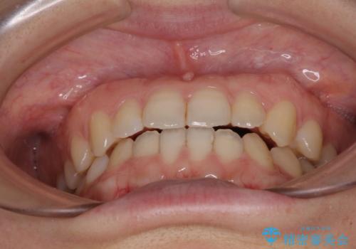 前歯のクロスバイト インビザラインによる矯正治療の治療中