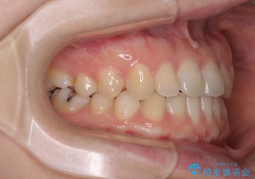 前歯のクロスバイト インビザラインによる矯正治療の治療中