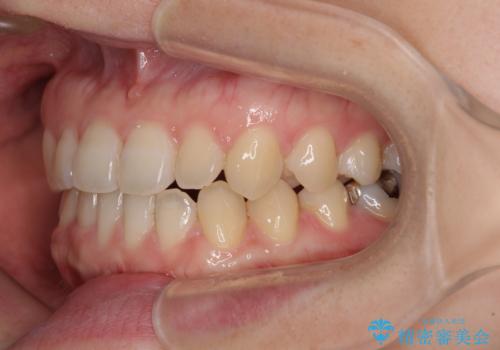 前歯のクロスバイト インビザラインによる矯正治療の治療中