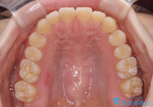 前歯のクロスバイト インビザラインによる矯正治療の治療中