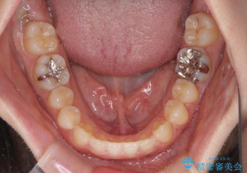 前歯のクロスバイト インビザラインによる矯正治療の治療中