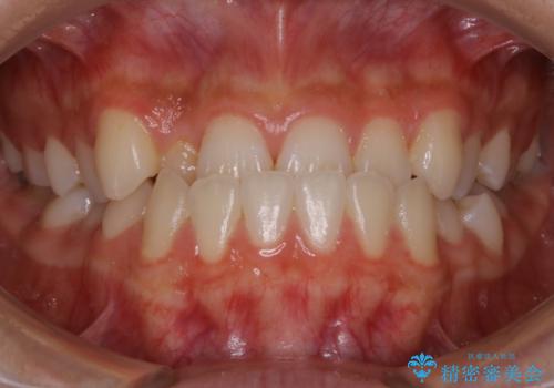 【非抜歯】受け口の改善　10代で始める本格的噛み合わせ治療の症例 治療前