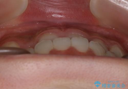 【非抜歯】受け口の改善 10代で始める本格的噛み合わせ治療の治療前