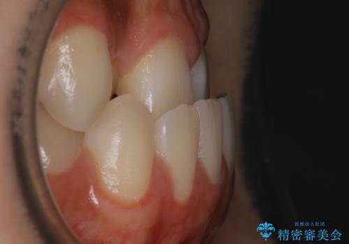 【非抜歯】受け口の改善 10代で始める本格的噛み合わせ治療の治療前