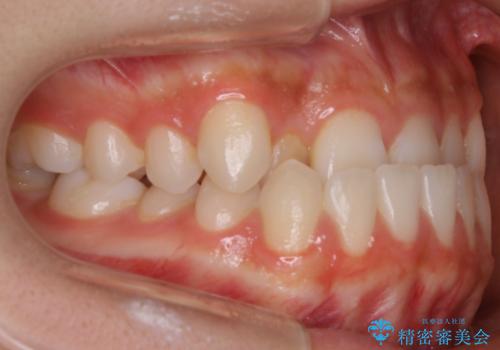 【非抜歯】受け口の改善 10代で始める本格的噛み合わせ治療の治療前