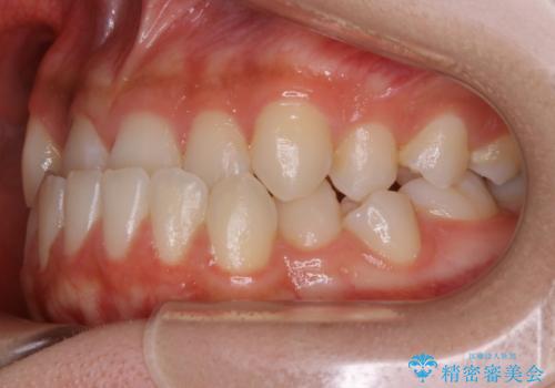 【非抜歯】受け口の改善 10代で始める本格的噛み合わせ治療の治療前