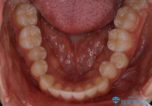 【非抜歯】受け口の改善　10代で始める本格的噛み合わせ治療の治療前