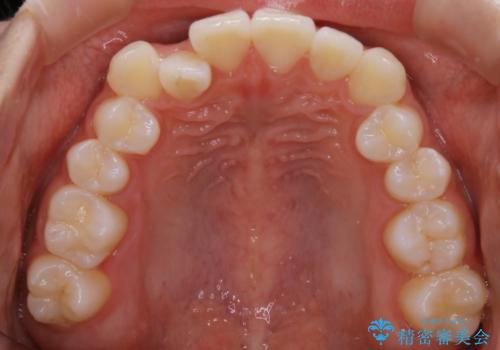 【非抜歯】受け口の改善　10代で始める本格的噛み合わせ治療の治療前
