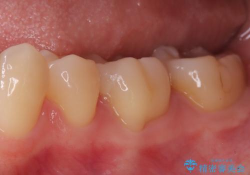 【ハイブリッドインレー】銀歯を白くしたい!の治療後