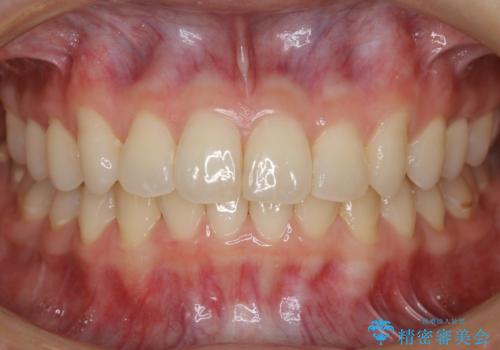 【非抜歯】結婚式に向けて矯正で素敵な笑顔を!の治療後