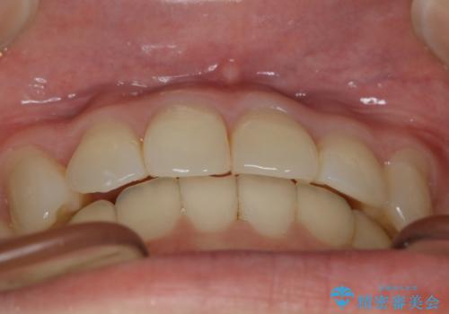 【非抜歯】結婚式に向けて矯正で素敵な笑顔を!の治療後