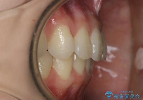 【非抜歯】結婚式に向けて矯正で素敵な笑顔を!の治療後