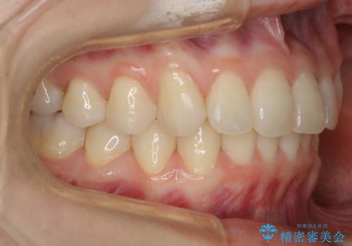 【非抜歯】結婚式に向けて矯正で素敵な笑顔を!の治療後