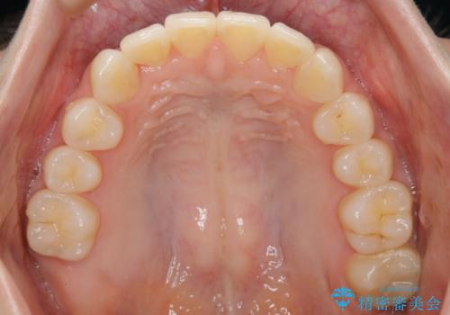 【非抜歯】結婚式に向けて矯正で素敵な笑顔を!の治療後