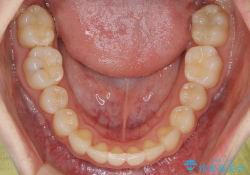 【非抜歯】結婚式に向けて矯正で素敵な笑顔を!の治療後