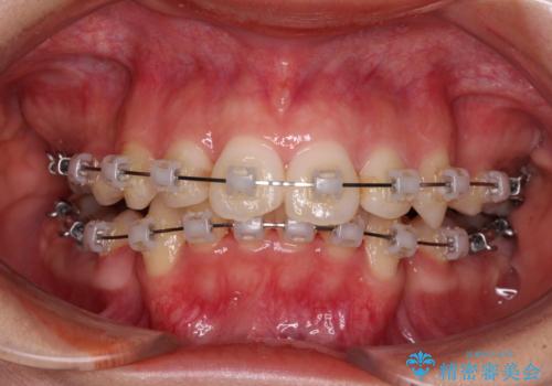 八重歯と乱れた咬み合わせを改善　ワイヤー装置での抜歯矯正の治療中