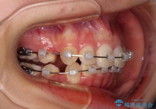 八重歯と乱れた咬み合わせを改善 ワイヤー装置での抜歯矯正の治療中