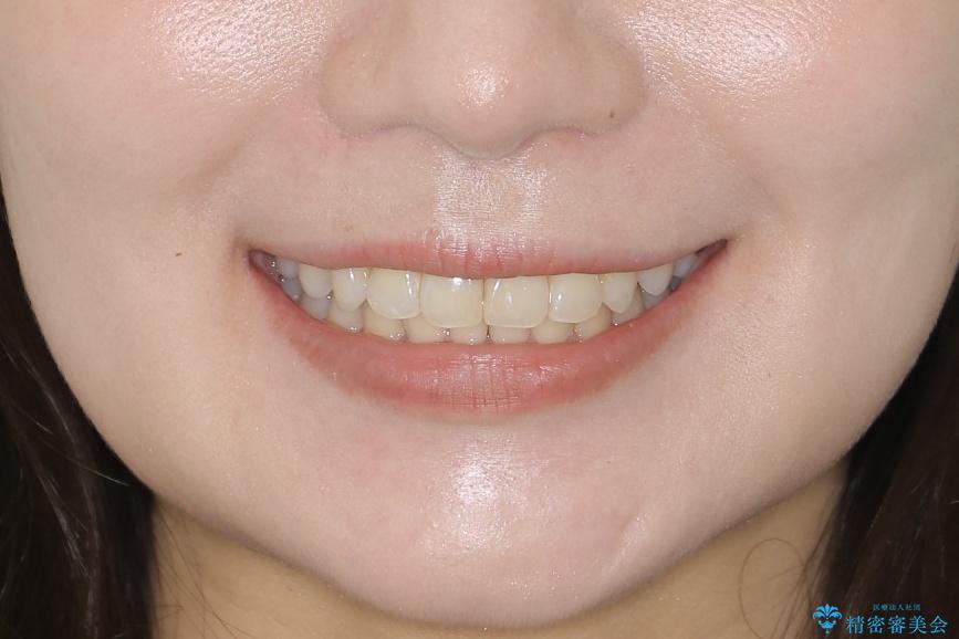【非抜歯】結婚式に向けて矯正で素敵な笑顔を!の治療後(顔貌)