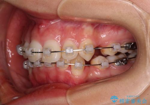 八重歯と乱れた咬み合わせを改善 ワイヤー装置での抜歯矯正の治療中