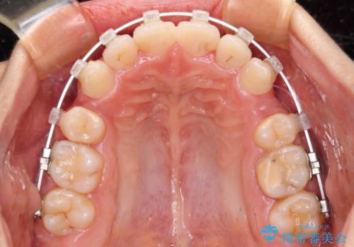 八重歯と乱れた咬み合わせを改善 ワイヤー装置での抜歯矯正の治療中