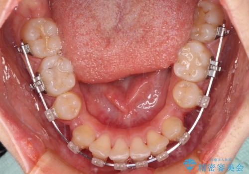 八重歯と乱れた咬み合わせを改善 ワイヤー装置での抜歯矯正の治療中
