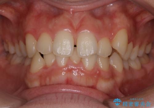 【非抜歯】すきっ歯と噛み合わせの治療の症例 治療前