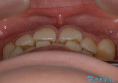 【非抜歯】すきっ歯と噛み合わせの治療の治療前