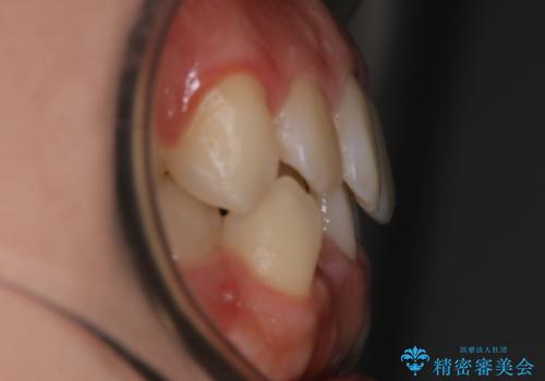 【非抜歯】すきっ歯と噛み合わせの治療の治療前