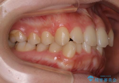【非抜歯】すきっ歯と噛み合わせの治療の治療前