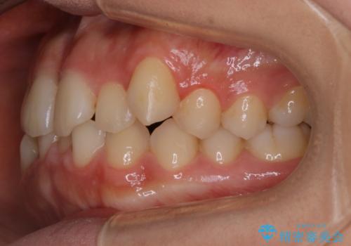 【非抜歯】すきっ歯と噛み合わせの治療の治療前