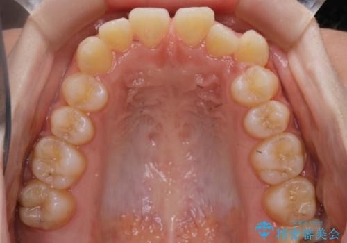 【非抜歯】すきっ歯と噛み合わせの治療の治療前