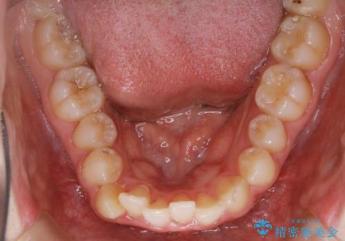 【非抜歯】すきっ歯と噛み合わせの治療の治療前