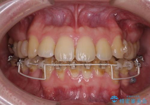 出っ歯と八重歯　目立たない裏側装置でスッキリとした口元にの治療中