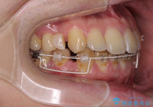 出っ歯と八重歯 目立たない裏側装置でスッキリとした口元にの治療中